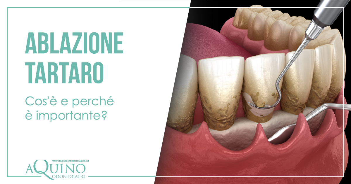 Ablazione tartaro, cos'è e perché è importante? | Studio Aquino