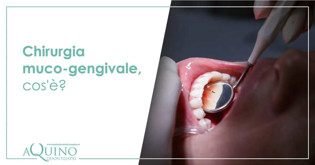 Chirurgia Paradontale - Centro di medicina